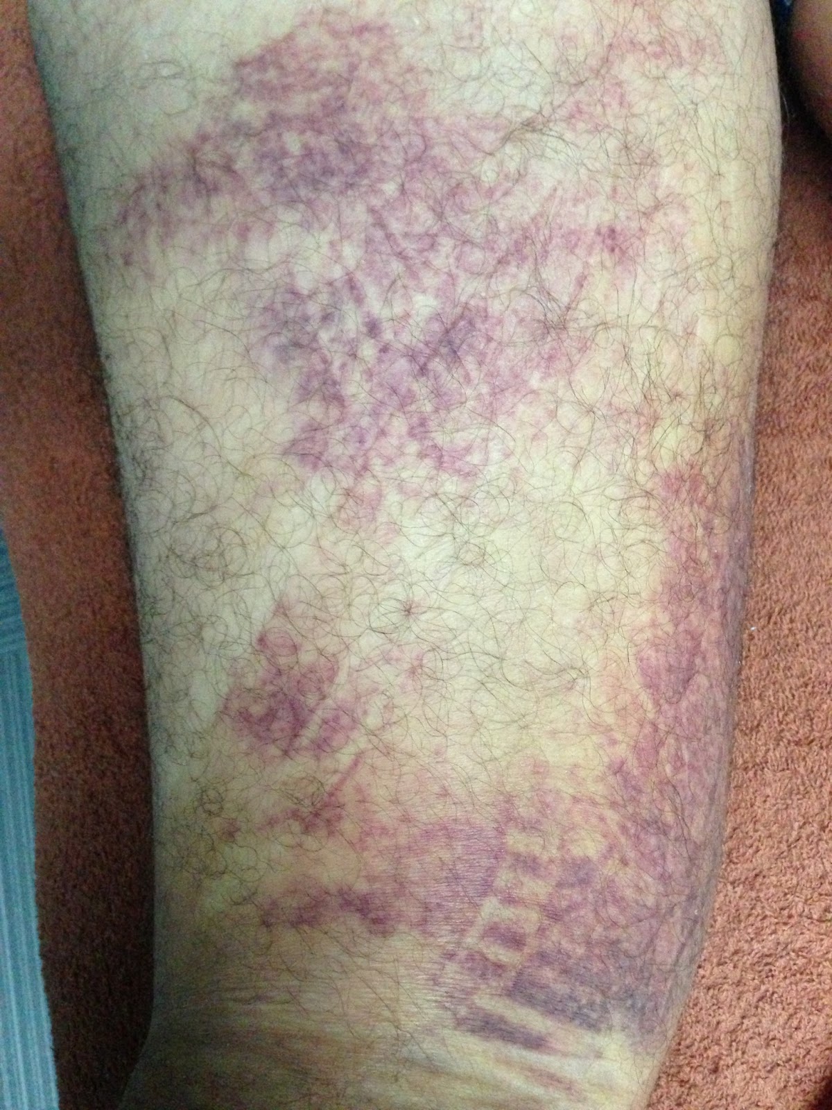 running-solutions-treatment-for-hamstring-tear
